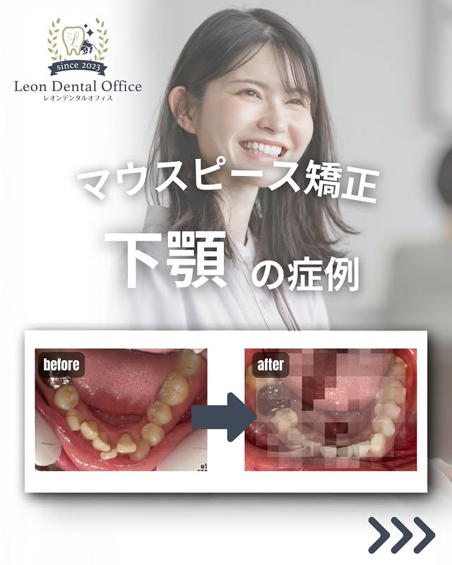 マウスピース矯正の下顎before/after症例|片顎矯正の費用相場の参考