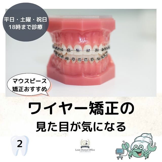 ワイヤー矯正の装置の見た目|マウスピース矯正との目立ちやすさの比較