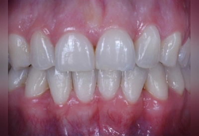 軽度の叢生(ガタガタ)のマウスピース矯正after|インビザライン費用相場の参考症例