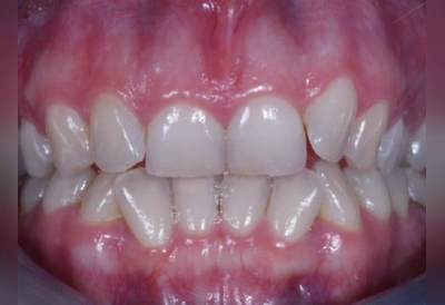 軽度の叢生(ガタガタ)のマウスピース矯正before|インビザライン費用相場の参考症例