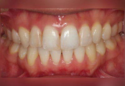 重度の叢生(ガタガタ)の矯正治療after|インビザラインによる症例