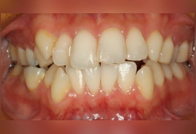 重度の叢生(ガタガタ)の矯正治療before|マウスピースとワイヤーどっちがいいか症状別で解説